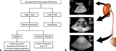 Evaluation of Asymptomatic Microscopic Hematuria by Renal Ultrasound to Detect Upper Tract ...