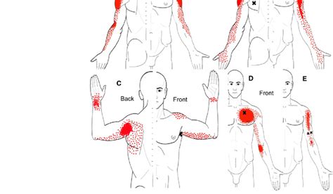 Diagram Of Shoulder Pain - Shoulder Pain Could It Be Your Rotator Cuff ...