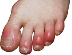 Chilblains Information from Walk Without Pain in Brisbane