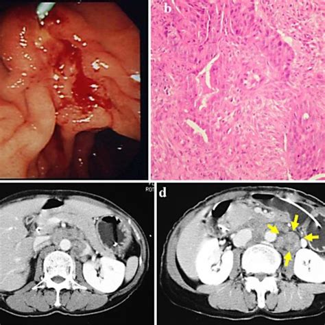 (PDF) A Case of Inoperable Duodenal Cancer Achieving Long-Term Survival after Multidisciplinary ...