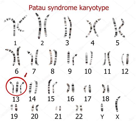 Patau syndrome karyotype — Stock Vector © zuzanaa #68702149