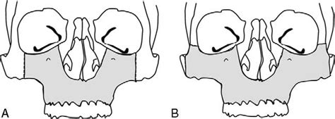 Composite picture of osteotomy designs for which the degloving approach... | Download Scientific ...