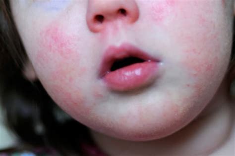 Rash: 36 Common Skin Rashes, Pictures, Causes & Treatment