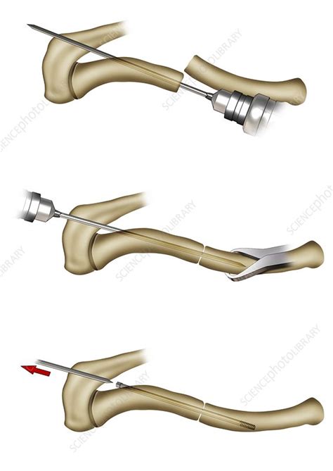 Clavicle fracture repair surgery, illustration - Stock Image - C047/3215 - Science Photo Library