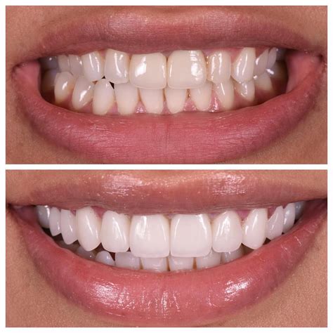 Dental Veneers Before and After - Dr. Apa Veneers Results | Teeth in ...