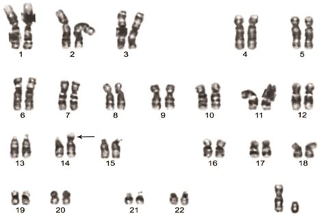 The karyotype showing typical Robertsonian translocation t(14;21) in Down syndrome case.