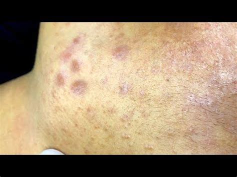 Acne Streatment With Sac Dep Spa #06 - YouTube | Acne treatment, Acne ...