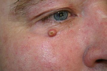 Nodule: Definition, Symptoms, Types, Causes, Diagnosis, Treatment and ...