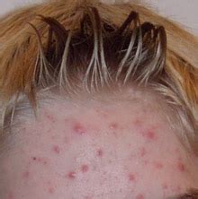 Scalp acne - Causes Scalp Acne, Remedial Measures, Prevention