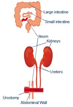 Overview of Stoma surgery for Healthcare professionals