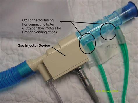 FREMITUS: Inhaled Nitric Oxide Set-up for Nitric Oxide Challenge