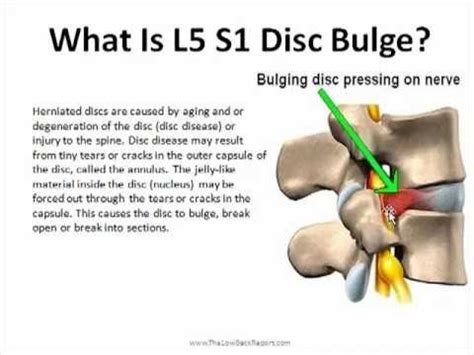 L5 S1 Disc Bulge.mp4 | Fibromyalgia/Pituitary Tumor/Vestibular Schwan…