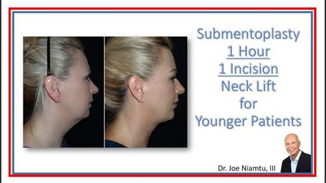 1 Incision, 1 hour Neck Lift (Submentoplasty) for Younger Patients