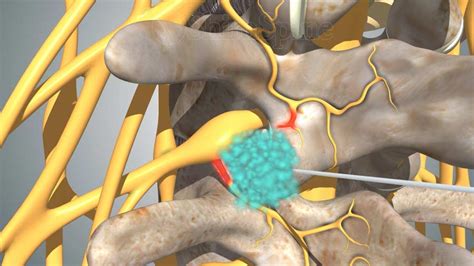 What is a facet injection? - ShimSpine