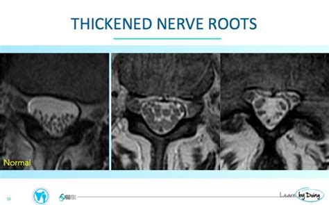 Arachnoiditis Patterns on MRI - Radedasia