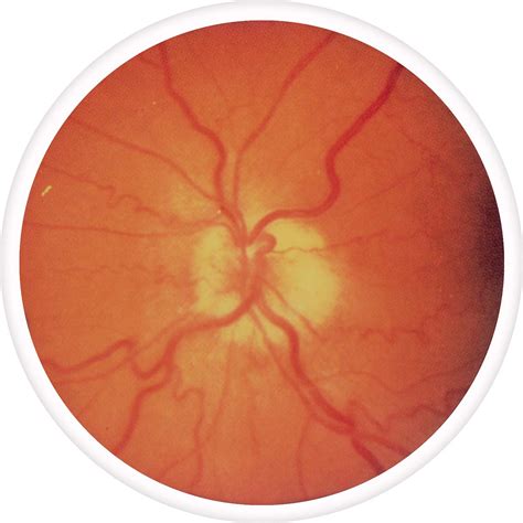 optic-neuritis - Diagnosis 101