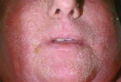 Erythroderma - Pictures, Treatment, Causes, Symptoms | HubPages