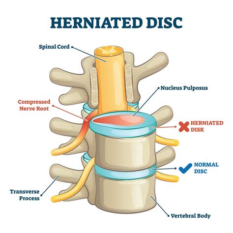 Ask Dr John Esq. - What Are Epidural Steroid Injections? - Diller Law ...