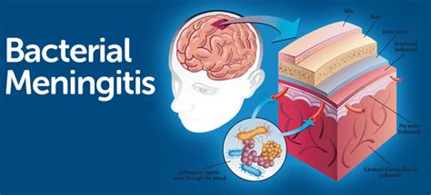 Bacterial meningitis causes, symptoms, diagnosis, prevention & treatment