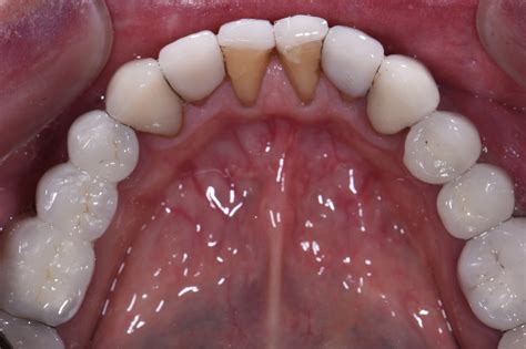 Severe Staining from Floradix | Iron Supplement Staining on Teeth