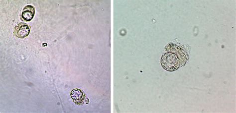 Urine Sediment of the Month: Don't be Fooled by Decoy Cells...A Clue to BK Polyomavirus ...