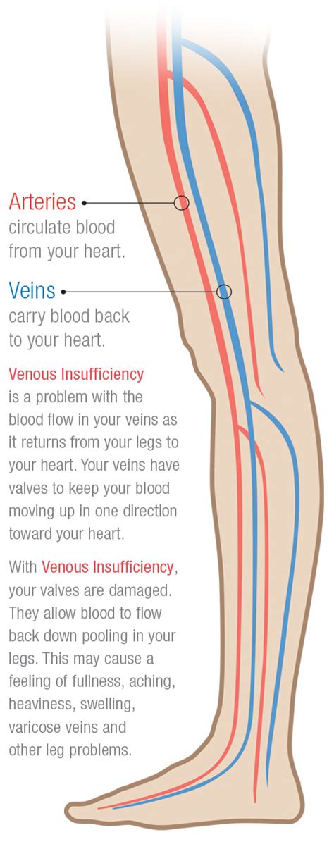 Venous Insufficiency - Vein Conditions | Triangle Vein Clinic - Cary, NC