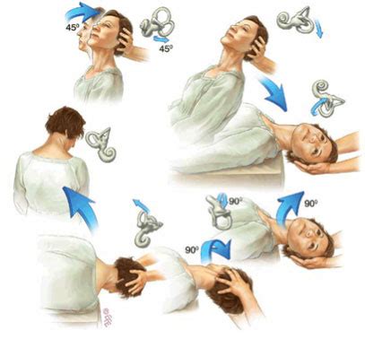 Physiotherapy treatment for vertigo (BPPV)