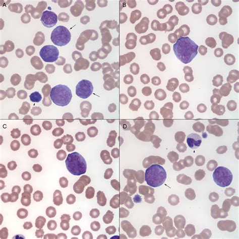 Blast versus promonocyte versus monocyte | eClinpath