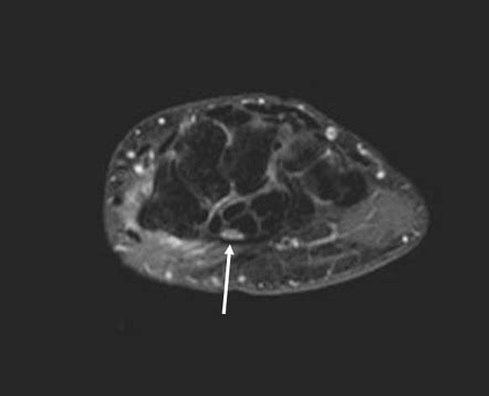 Carpal tunnel syndrome (MRI) | Radiology Case | Radiopaedia.org