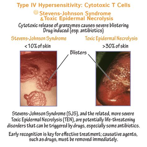 Clinical Pathology Glossary: Stevens-Johnson Syndrome & Toxic Epidermal ...