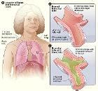 Chronic Bronchitis: Symptoms, Diagnosis and Treatment - Symptoma®