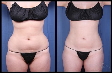 SmartLipo Triplex vs. Traditional Liposuction - Omaha Liposuction by Imagen