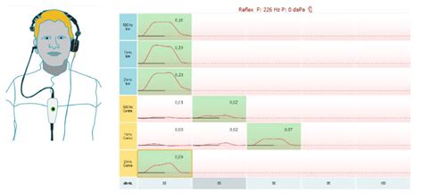 Titan | Acoustic Reflex Testing | Interacoustics