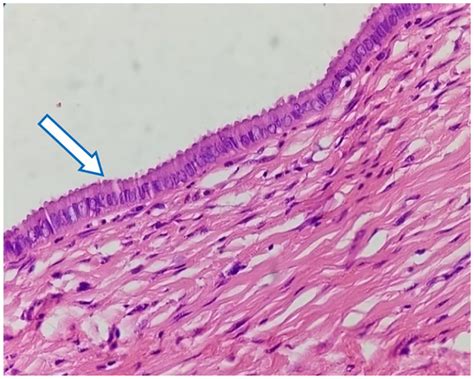 Nabothian cyst; inner cyst wall lined by single layer of ciliated low... | Download Scientific ...