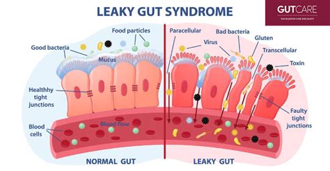 All You Need To Know About Suffering From Leaky Gut Syndrome | GUTCARE