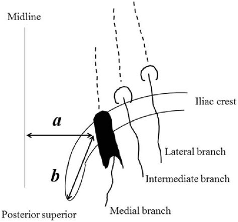 Superior Cluneal Nerve Symptoms - Cluneal Nerve Block | Nevada Pain - Las Vegas, Henderson : A ...