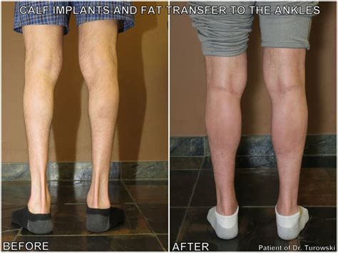 http://drturowski.com/calf-augmentation-before-and-after-pictures | Calves, Augmentation, Health