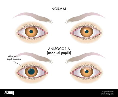 Pupil disorders Stock Vector Images - Alamy