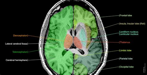 Brain MRI 3D: normal anatomy | e-Anatomy