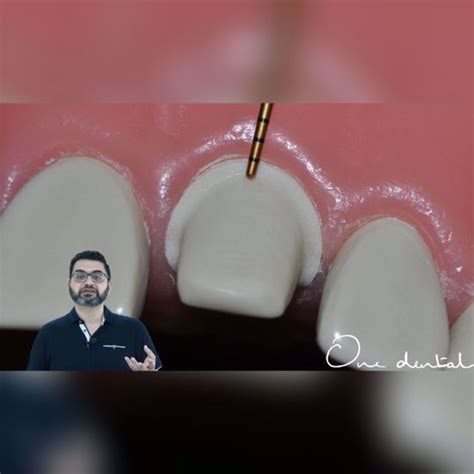 Detailed demonstration of tooth preparation of an incisor for a PFM crown-One Dental is the ...