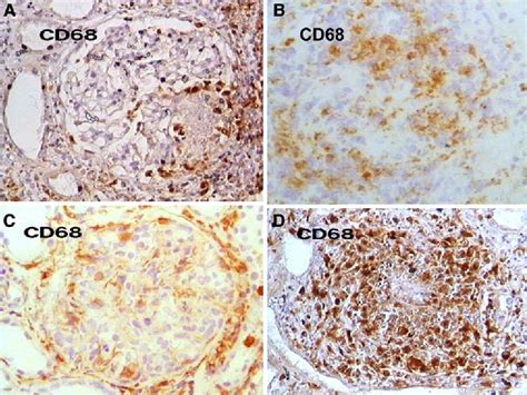 Pathology of ANCA-associated vasculitis | Semantic Scholar