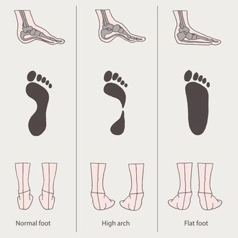 A Simple Overview of What Causes Flat Foot