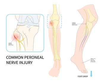 Surgical Options to Treat Common Peroneal Neuropathy | Baltimore Nerve ...