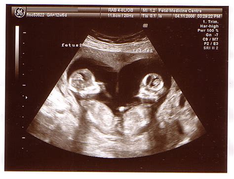 Twins - 12 Week Scan (Heart shaped) | Its official, there's … | Flickr