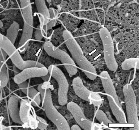 H pylori bacteria infection symptoms, diagnosis and treatment