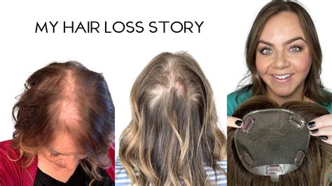 My Hair Loss Story - YouTube