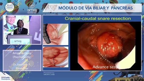 Lecture: Ampullectomy (Papillectomy). AMEG 2019 - YouTube