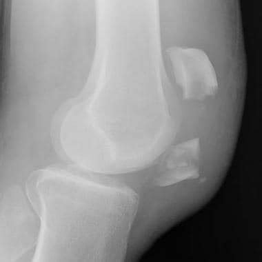 Patella Fracture Imaging: Practice Essentials, Radiography, Computed Tomography