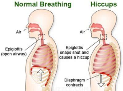 Hiccups: Why Do We Get Them? How to Get rid of it? - Procaffenation