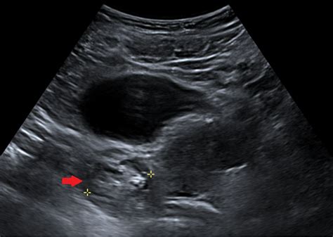 Cureus | Not Your Average Seizure: A Case of N-Methyl-D-Aspartate ...